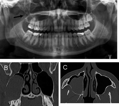 Computerized Tomography Findings And Recurrence Of Keratocystic