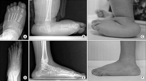 Results Of Surgical Treatment For Congenital Vertical Talus