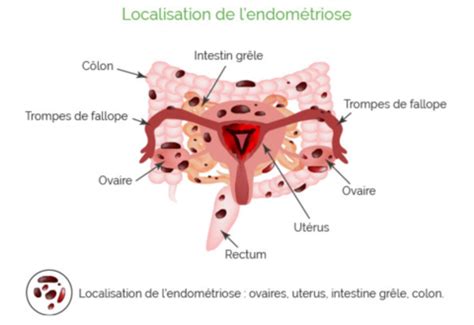 Diagnostic de lendométriose Laboratoires SALEM