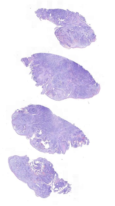 Composite Merkel Cell Carcinoma With Ttf Immunopositivity Kiko Xp