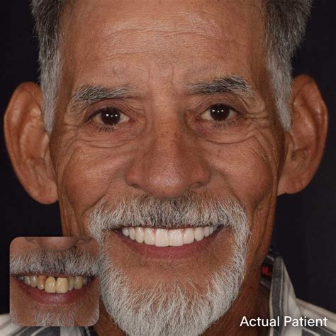 Doctors Implants – Full Mouth Dental Implants