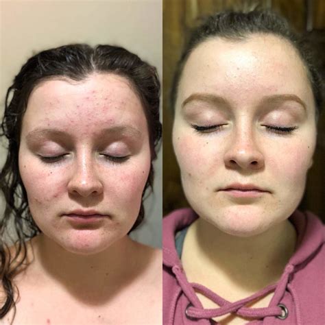 Benzoyl Peroxide Results