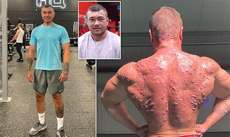 Bodybuilder Is Covered With Horrific Scars After Steroid Use Daily