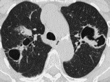 Apical Pleural Thickening Tb