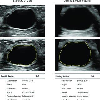 S Detect Interpretation Of A Cyst On Standard Of Care And Vsi B Mode