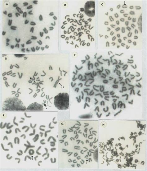 Bone Marrow Metaphase Spreads Showing A Normal Chromosomes B