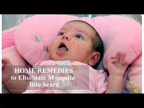 Home Remedies to Eliminate Mosquito Bite Scars