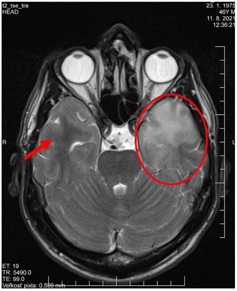 Brain Sciences Free Full Text Neurosyphilis Presenting As Syndrome