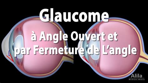 Pathologie Du Glaucome Animation YouTube