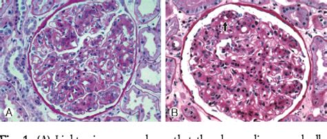 Figure 1 From A Case Of Membranoproliferative Glomerulonephritis In A Patient With Type 2