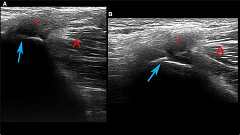 Adductor Muscles Ultrasound