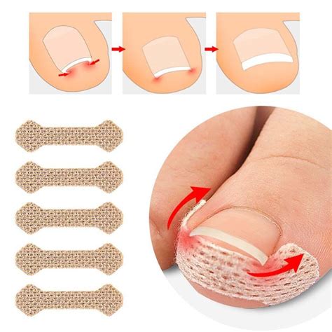 Cheap 10Pcs Set Ingrown Toenail Correction Tool Nail Treatment