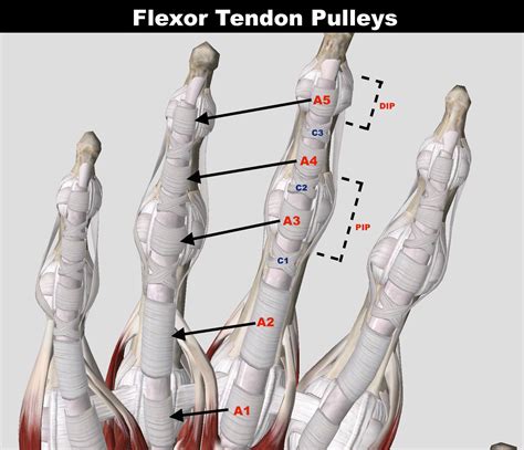 Finger Pulley Rupture