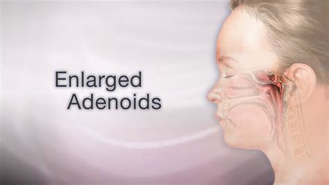 Adenoid Face Before And After