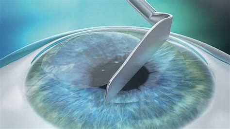 PRK/LASEK Experts - lasik-info.com - All about LASIK, Femto-LASIK ...