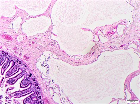 Lymphangioma Histology