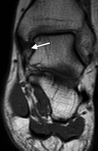 Deltoid Ligament Tear