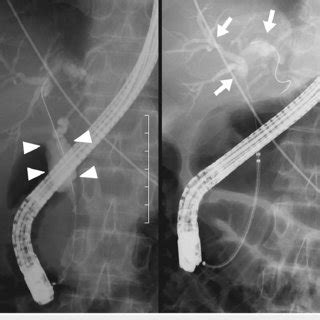 Endoscopic Retrograde Cholangiopancreatography Revealed A Markedly