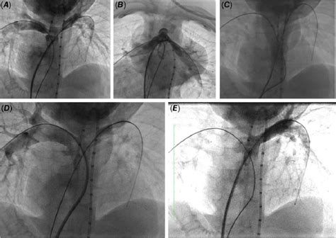 TGA s/p arterial switch, 5-year bilateral pulmonary branch stenosis ...