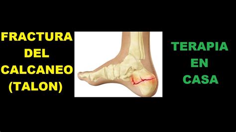 Fractura De Calcaneo Qu Es Causas S Ntomas Tratamiento Y Consejos