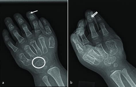 Radiographs Of The Left Hand A Posteroanterior View Showing