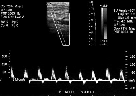 Duplex Ultrasonography Of Vertebral And Subclavian Arteries Journal