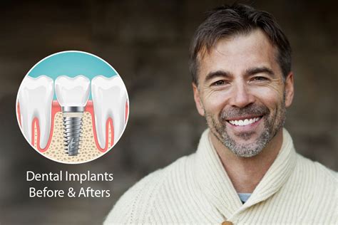 Dental Implants Beverly Hills Best Implants Dentist Beverly Hills Ca