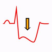 Infarto NSTEMI Fisiologia E Patologia Elettrocardiografica