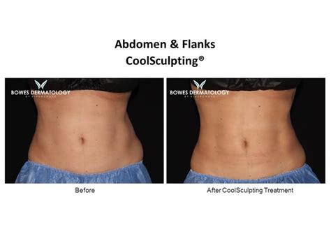 Abdomen and Flanks Results – Photo #1 | CoolSlim