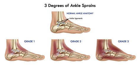 Rehabilitation Of A Sprained Ankle Physiotherapy At Home