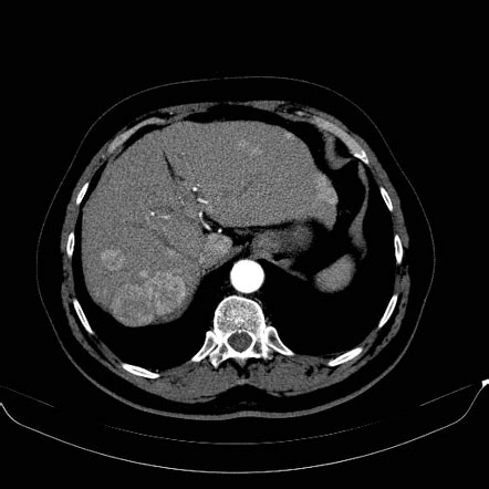 Multifocal Hepatocellular Carcinoma Probable Image Radiopaedia Org