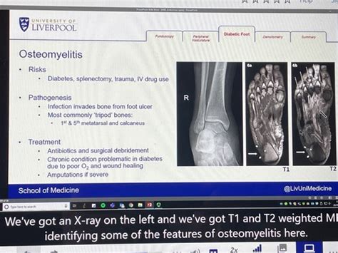 Bone And Joint Infections Flashcards Quizlet