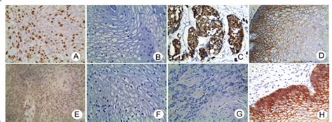 Immunostaining Of Foxm1 β Catenin Tcf4 And E Cad In Escc And Control Download Scientific