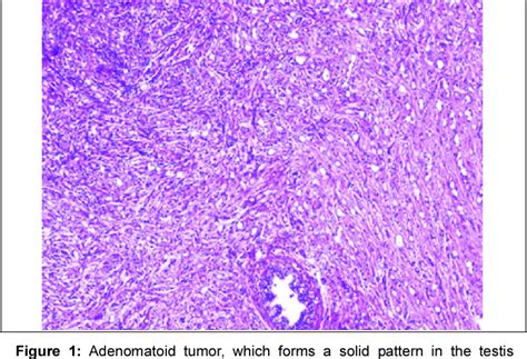 Figure 1 From Diagnosis And Treatment Of Paratesticular Adenomatoid