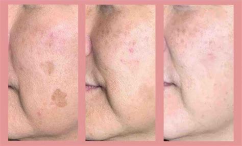 Plasma Fibroblast Pigmentation Treatment Age Dark Spot Removal Treatment