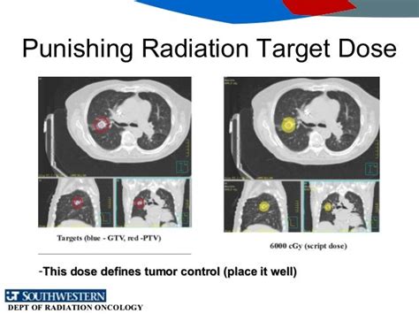 sbrt for inoperable lung cancer