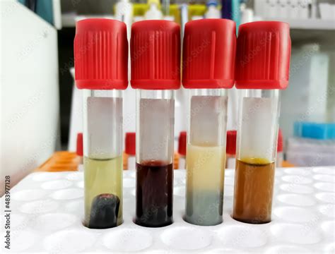 Common types of blood serum sample errors. Different types of sample ...