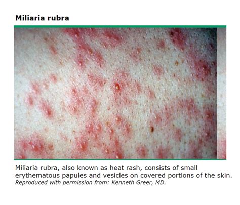 요양원 환자 홍색 땀띠 miliaria rubra heat rash