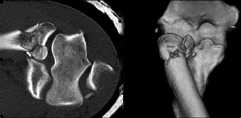 Pre Operative Ct Scans Showing A Mason Type Iii Fracture Of The Radial