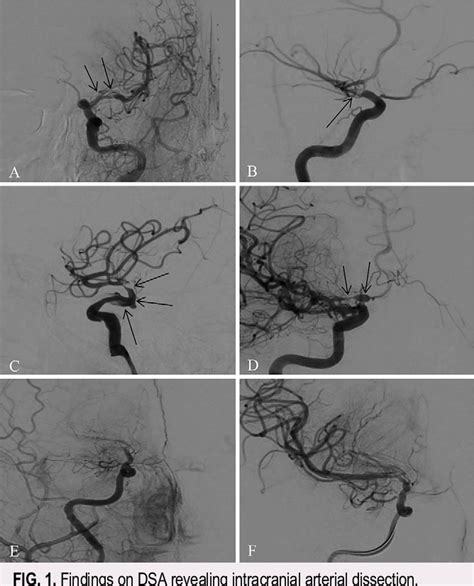 Pdf Ischemic Stroke Caused By Spontaneous Anterior Circulation