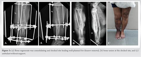 Post Traumatic Large Segmental Bone Loss Does Bone Transport Obviate