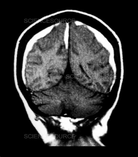 Mri Of Bilateral Subdural Hematomas Stock Image Science Source Images