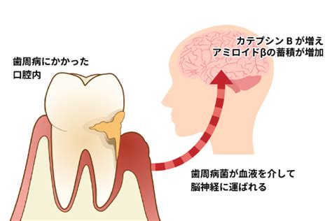 歯周病と認知症 しばた歯科のスタッフブログ