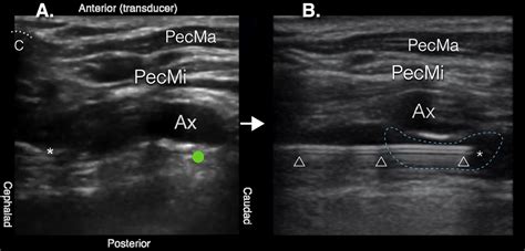 Ultrasoundguided Retroclavicular Approach Infraclavicular Brachial