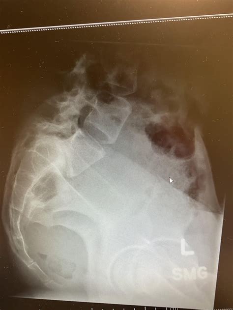 12/30 photo update from l4-l5-s1 fusion surgery on 12/19 : r/spinalfusion