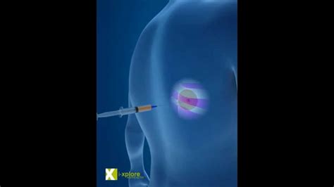 Lung Cancer Biopsy Youtube