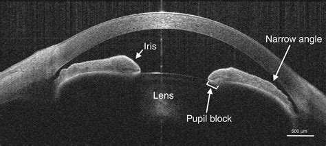 Anterior Segment Optical Coherence Tomography And Its Clinical