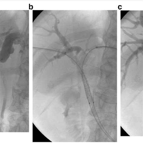 A 48-year-old woman with a Klatskin tumor presented with obstructive ...