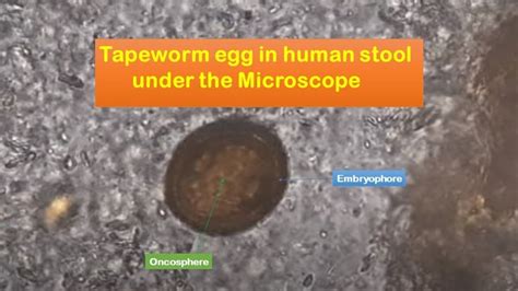 Tapeworm eggs in human stool under the Microscope | Stool, Microscope ...