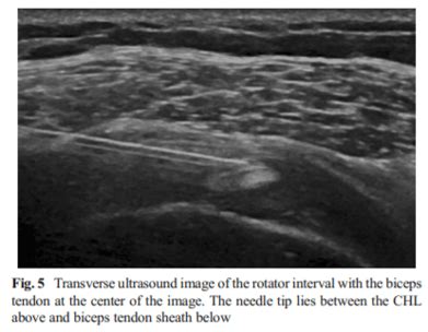 Dr David Samra Sports Medicine Sydney Frozen Shoulder